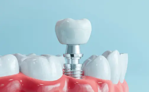 Implantología Avanzada